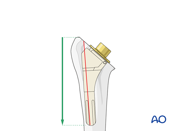 Humeral osteotomy – a single cut is performed from the proximal to the distal aspect of the stem