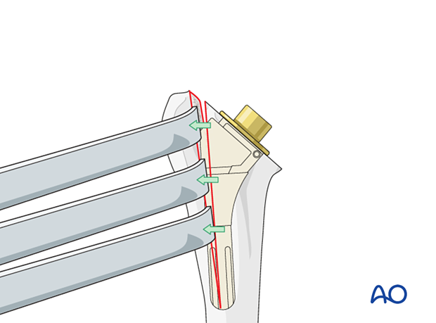 Humeral osteotomy – multiple osteotomes are inserted in the cut to spread it open