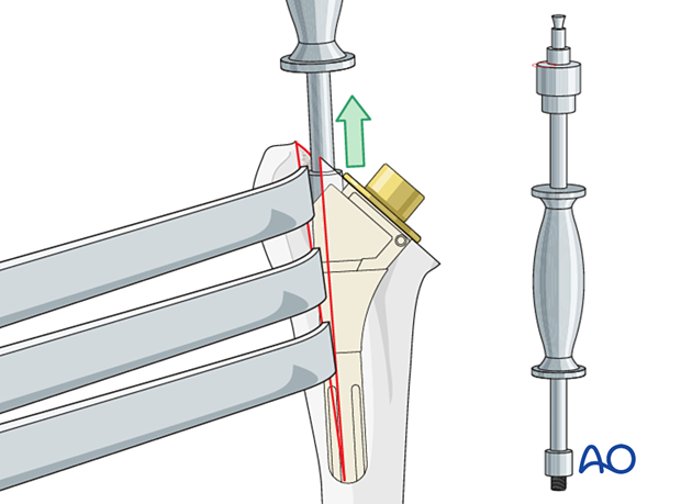 Humeral osteotomy – the revision extractor instrument is attached to the stem and backslapped in the axis of the humerus