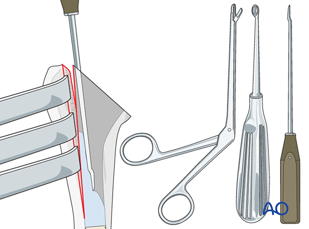 Humeral osteotomy – if the implant is cemented, and cement remains in the medulla after removal of the implant, the cement is removed with osteotomes, curettes, and rongeurs