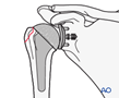 Avulsion of the greater tuberosity