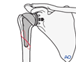 Humeral implant loose good bone