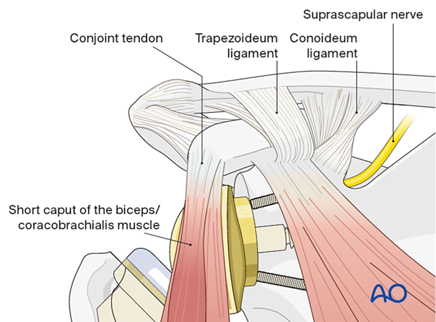 View of shoulder with reverse prosthesis