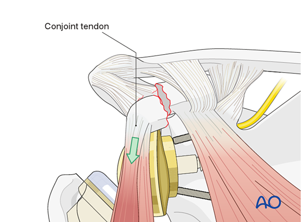 View of shoulder with reverse prosthesis showing conjoint tendon and suprascapular nerve