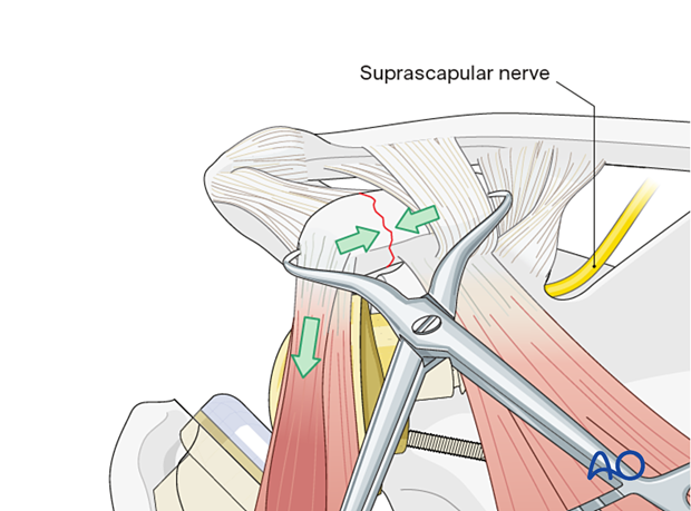 Reduction of a coracoid fracture