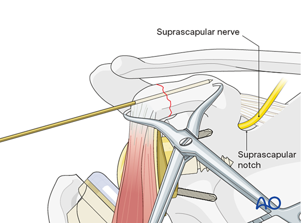 Temporary fixation of a coracoid fracture with a K-wire