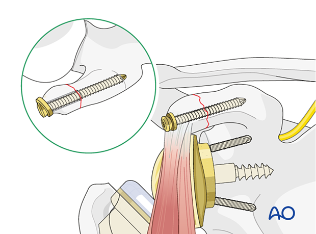 orif lag screw fixation of the coracoid