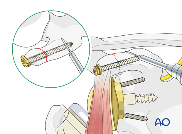 per 10 P100 A1 ORIF - Lag screw fixation