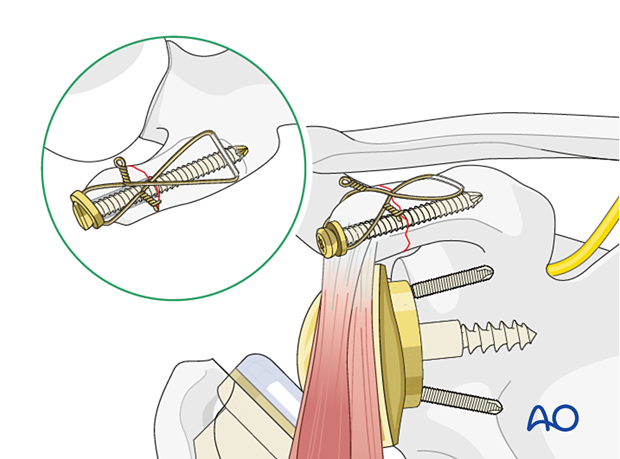 cerclage to increase stability of a coracoid fracture – a cerclage wire or a strong nonresorbable suture is inserted and secured in a figure-of-eight fashion