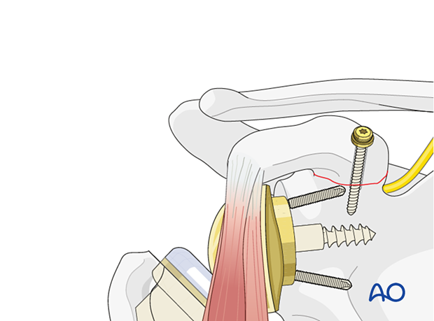 Fixation of a fracture of the coracoid base