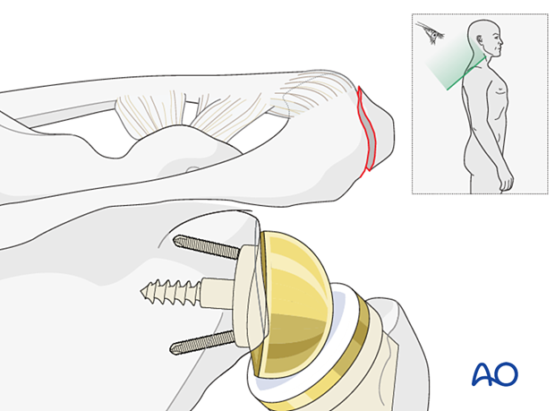 Periprosthetic fracture of the acromion 