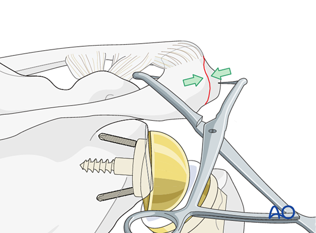 Periprosthetic fracture of the acromion – achieving reduction with a reduction clamp