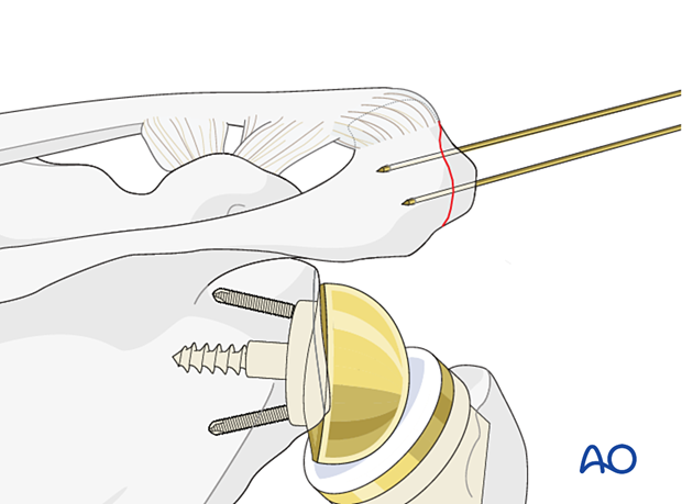 Periprosthetic fracture of the acromion – K-wire insertion