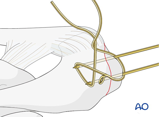 Periprosthetic fracture of the acromion – looping a cerclage wire around the two K-wires