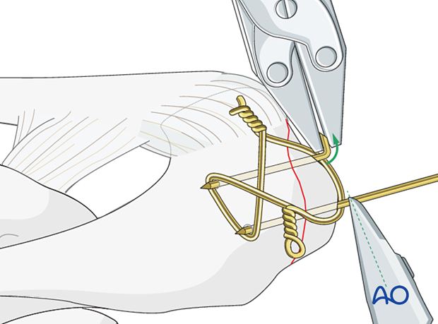 Periprosthetic fracture of the acromion – the K-wires are shortened and bent.