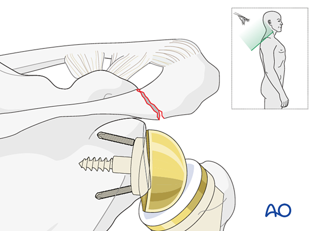 Periprosthetic fracture of the acromion