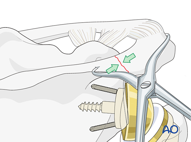 Reduction of a fracture of the acromion