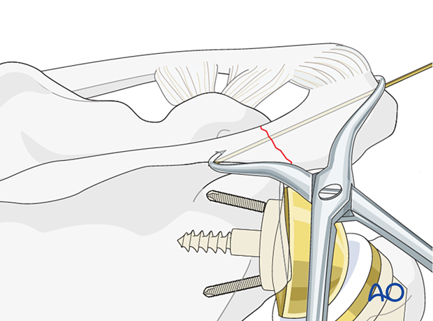 Acromion fracture – K-wire insertion 