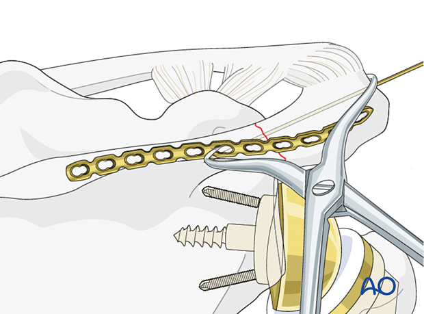 Acromion fracture – plate contouring