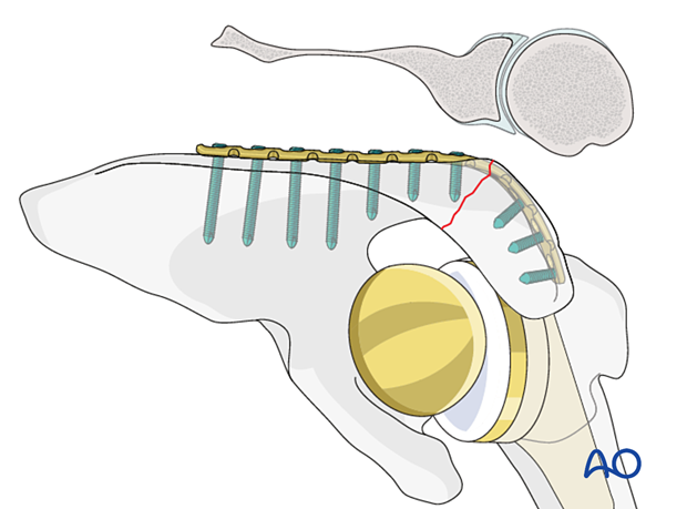 Acromion fracture – screw length and direction