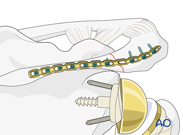 Acromion fracture – screw insertion