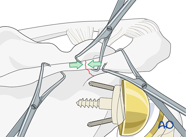 Reduction of a fracture of the scapula spine 