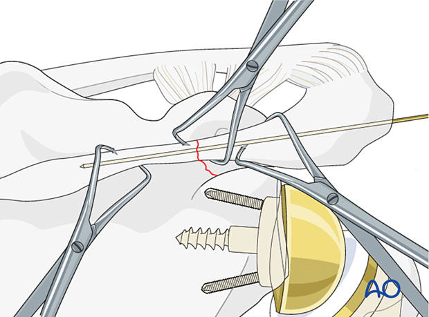 Scapula spine fracture – holding the reduction with a K-wire