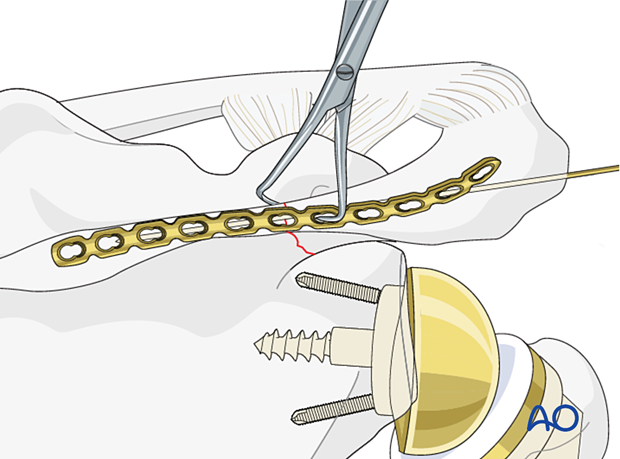 Scapula spine fracture – plate contouring