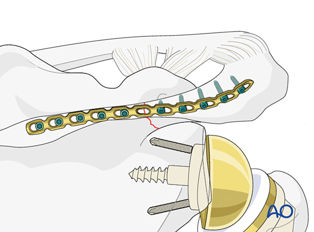 Scapula spine fracture – screw insertion