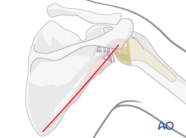 Posterior approach to the scapular body