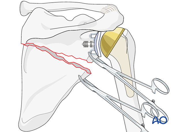 Periprosthetic fracture of scapula body - reduction