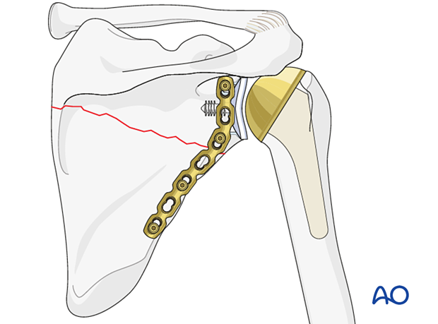 orif plate fixation