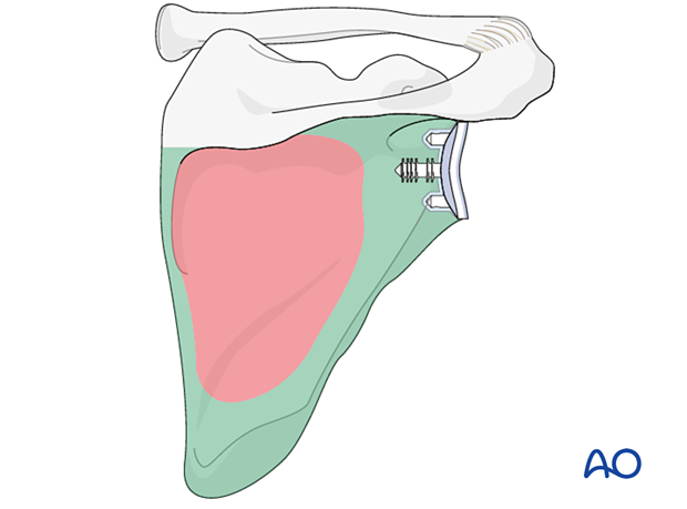 Periprosthetic fracture of scapula body - regions of optimal bone thickness appropriate for plate fixation are shown in green