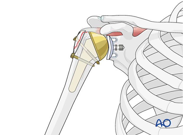 Avulsion of greater tuberosity- ORIF – suture fixation