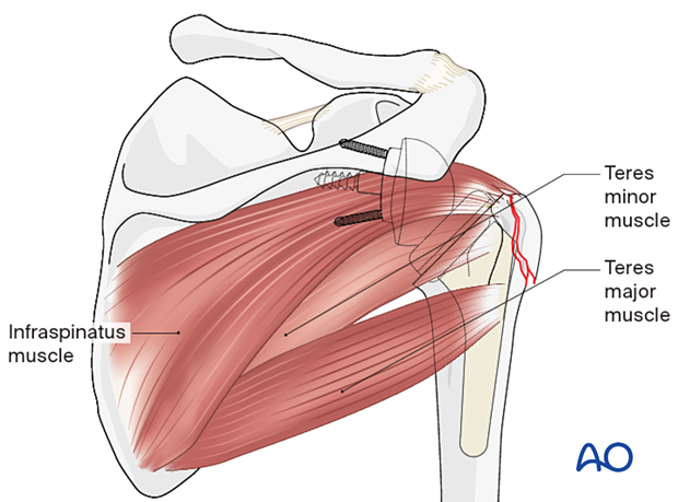 In the case of a reversed shoulder prosthesis, continuity of the infraspinatus/teres minor to the humerus is the objective