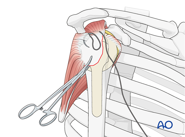 Avulsion of greater tuberosity - insert stay sutures through the supraspinatus and the infraspinatus tendon if necessary.