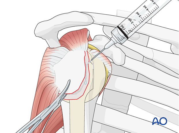 Avulsion of greater tuberosity - clean the fracture bed and remove any hematoma.