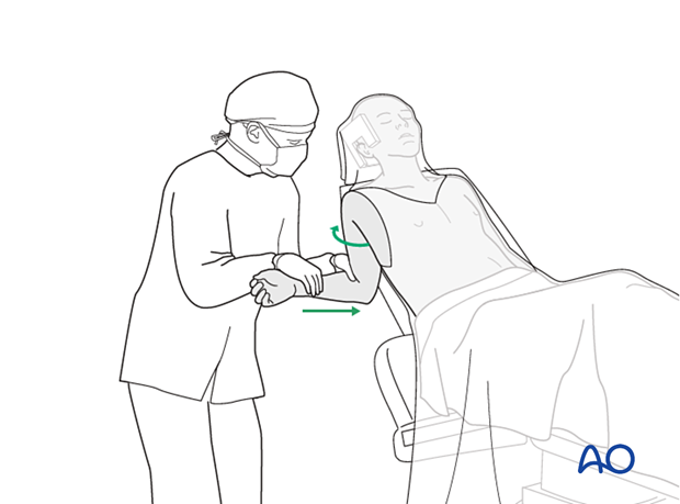 Avulsion of greater tuberosity - Rotation of the arm brings the fragment into anatomical alignment with the bony defect, while avoiding excessive traction force 