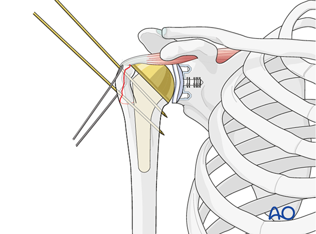 Avulsion of greater tuberosity - temporarily secure the reduction with 1 or 2 K-wires.