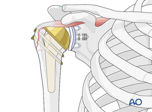 Avulsion of greater tuberosity - screw fixation