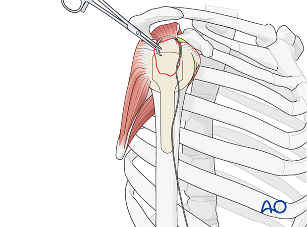 Avulsion of greater tuberosity - suture insertion into rotator cuff tendon