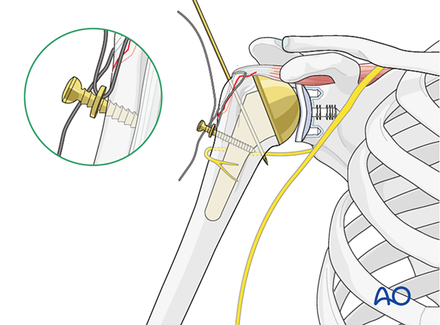 Avulsion of greater tuberosity - suture passed through a washer