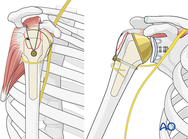 Avulsion of greater tuberosity - suture tightened and tied