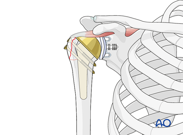 Avulsion of greater tuberosity - once the lag screw(s) are inserted, the K-wire(s) used for temporary fixation, and any stay sutures, should be removed