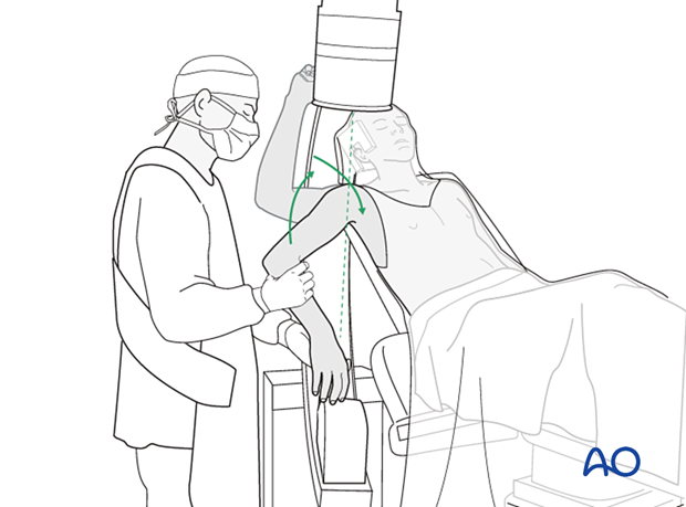 In the beach chair position, the C-arm must be directed appropriately for orthogonal views.