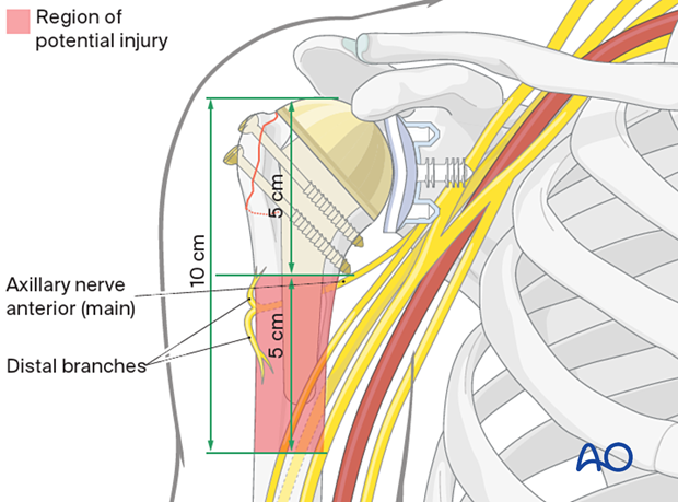 Avulsion of greater tuberosity - measures should be taken to avoid damaging the axillary nerve