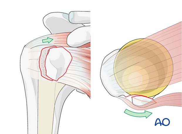 The lesser tuberosity is typically displaced anteriorly due to the pull of the subscapularis