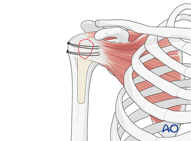 Avulsion of lesser tuberosity - suture fixation