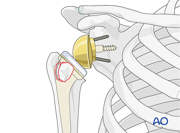 Avulsion of lesser tuberosity - in the case of a reversed shoulder prosthesis, the need for continuity of the subscapularis to the humerus is debated.