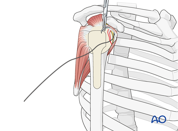 per 10 P200 A2 ORIF - Suture or screw fixation